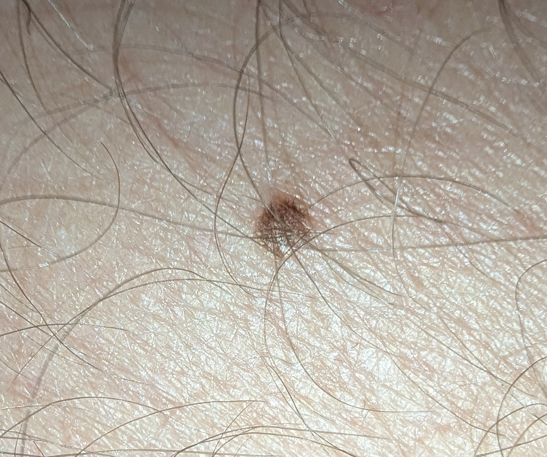 Example 1: clear, centered, well-lit mole